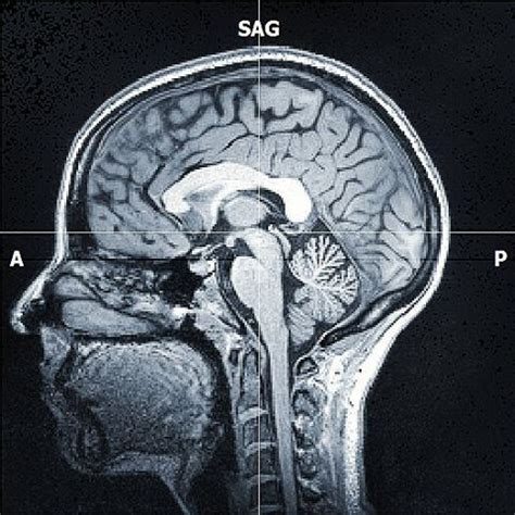 an mri scan shows the location of the brain and its structures ...