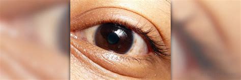 Baggy eyes treatment | General center | SteadyHealth.com