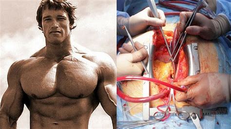 Arnold Schwarzenegger Open Heart Surgery - YouTube