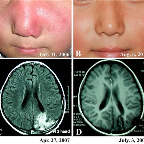 A patient (case 3) showed partial improvement of skin lesions and ...