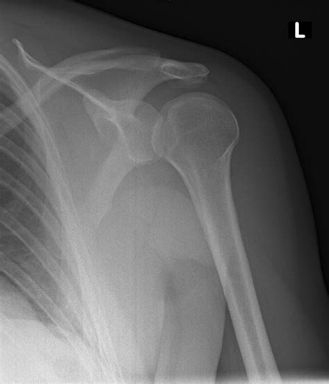 Anterior Shoulder Dislocation Reduction