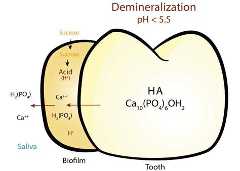 remineralization-1 - Decisions in Dentistry