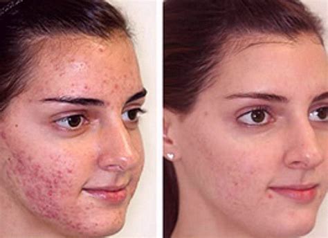 Amazing Remedies And Treatments To Treat Acne Scars