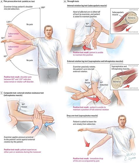 JAMA Network on Instagram: "Rotator Cuff Disease – Physical Exam A ...