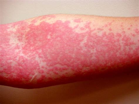 Allergic to water: Aquagenic Urticaria: - MEDizzy Journal