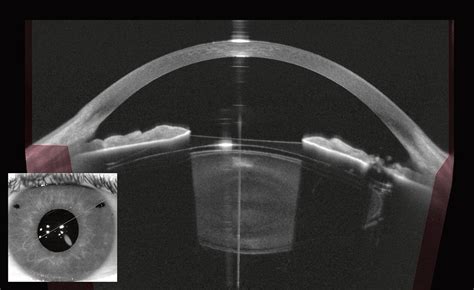 Optical Coherence Tomography Imaging | Opthalmologist Tools