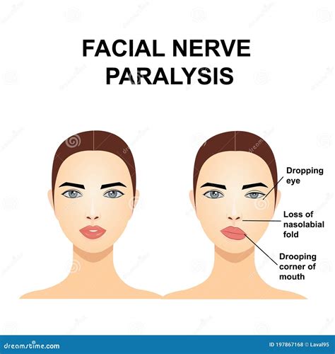 Paralysis Of The Facial Nerve. Bell`s Palsy Vector Illustration ...