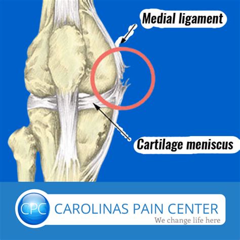 Acute Knee Ligament Tear - Carolinas Pain Center