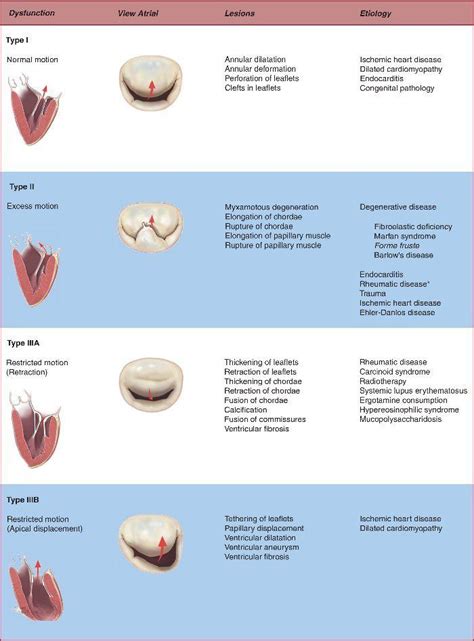 Mitral Regurgitation Explained • MyHeart.net | Mitral valve, Mitral valve regurgitation, Valvular