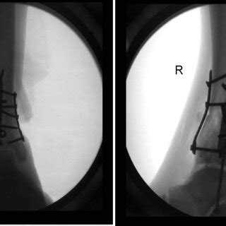 Anterior-posterior and lateral radiographs demonstrating syndesmotic... | Download Scientific ...