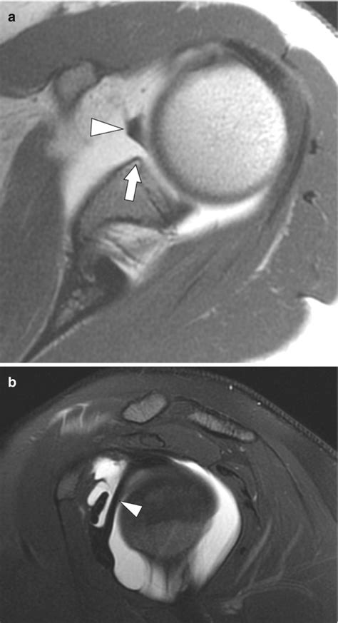 Fig. 1.10, [Buford complex normal labral variant]. - Musculoskeletal Diseases 2021-2024 - NCBI ...