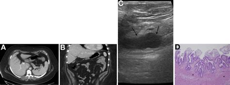 A Woman With Chronic Postprandial Abdominal Pain and Vomiting - Gastroenterology