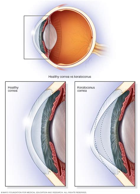 Keratoconus - Symptoms and causes - Mayo Clinic