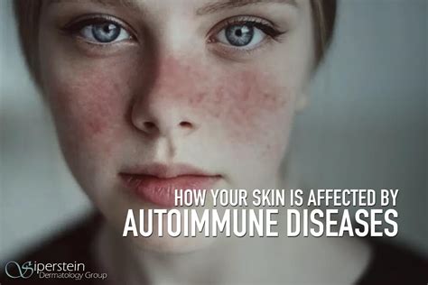 The Link Between Autoimmune Diseases And Your Skin