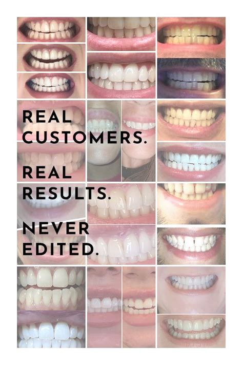 Have you seen some of the real customer reviews for our at home teeth ...