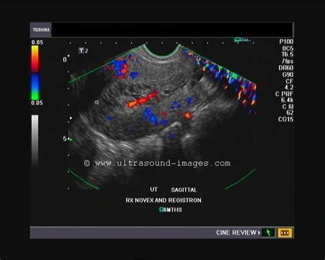 cystic-hyperplasia | Uterus, Gynecology, Ultrasound