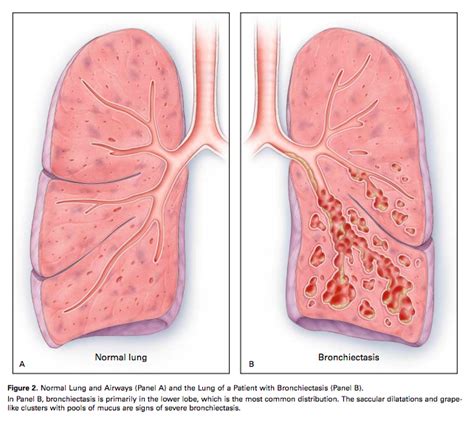 Bronchiectasis - Physiopedia