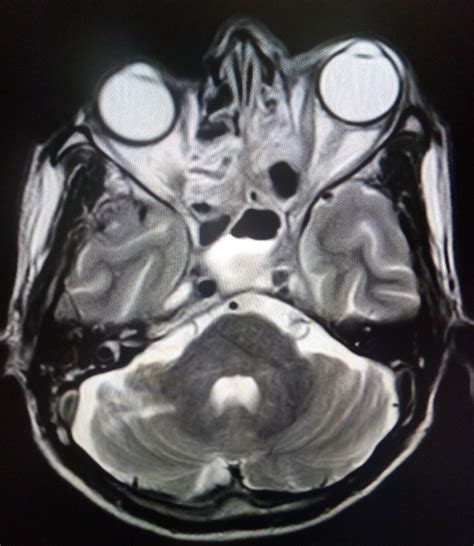 Cavernous Sinus Thrombosis: Case Report - Sumer's Radiology Blog