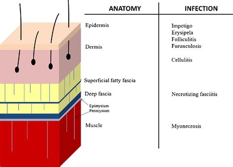 Necrotizing Fasciitis Stages