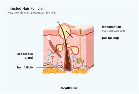 Recurring Boils: Causes and Treatment