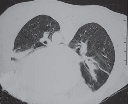 - Computed tomography scan of the chest in the ventral decubitus... | Download Scientific Diagram