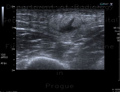 Radiology case: Atheroma, arm