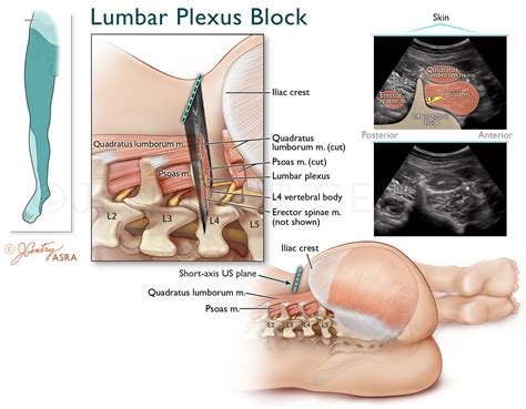 Lumbar Plexus Block