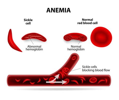 Abnormal types of hemoglobin, Sickling of RBCs, Types & causes of ...