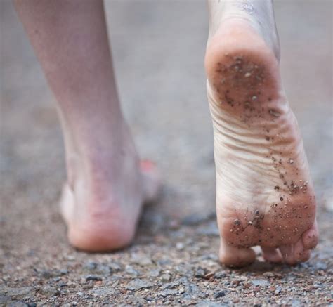 Fissures & Athlete's Feet Treatment | Livestrong.com