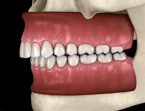 Can Invisalign Fix My Bite Problems?