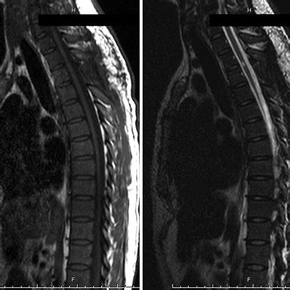 Sagittal MR images obtained 6 months postsurgery. Note the signs of ...