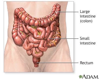 Colon cancer Information | Mount Sinai - New York