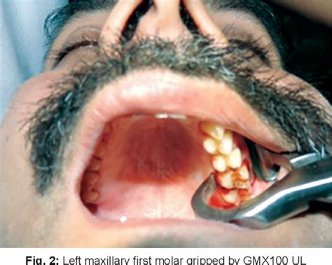 Physics Forceps vs Conventional Forceps in Extraction of Maxillary 1st Molar | Semantic Scholar