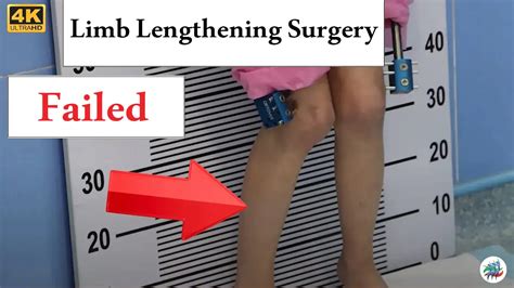 Unsuccessful experience of limb lengthening surgery (Failed)