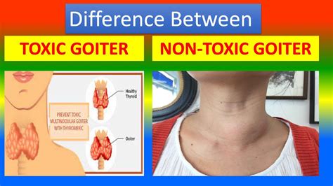 Difference Between Toxic .Goiter and Nontoxic Goiter - YouTube