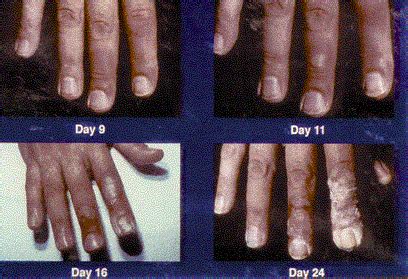 Cutaneous Radiation Injury (CRI): Information for Clinicians ...