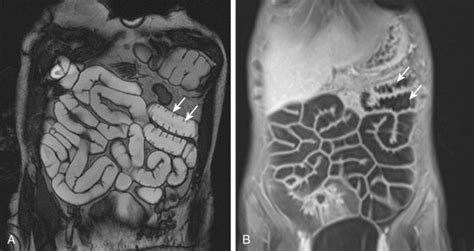 Magnetic Resonance Enterography | Radiology Key