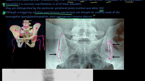 96P Introduction to the Seronegative Spondyloarthropathies - YouTube