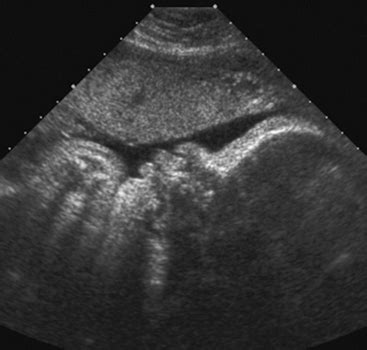 FETAL SYNDROMES | Radiology Key