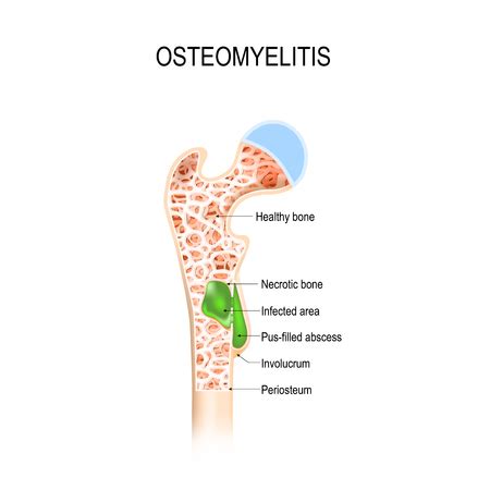 An "Interview" with the OVIVA Study of Oral vs. IV Antibiotics for ...