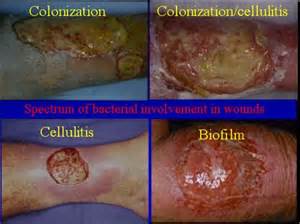 Wound Bed Preparation Pdf - helperlabels