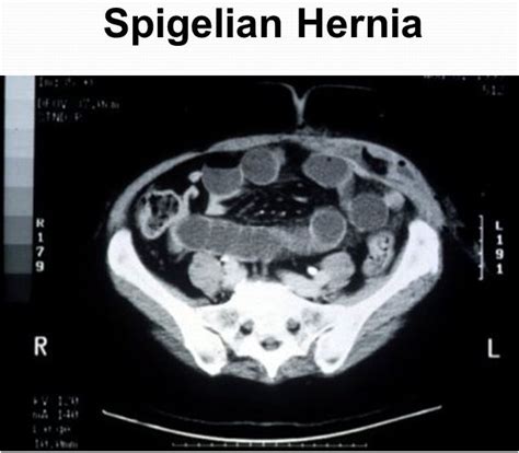 Spigelian Hernia Symptoms, CT, Pictures, Causes, Repair Procedure