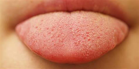 Why tongue pain happens and how to cure it? – Healthy Flat