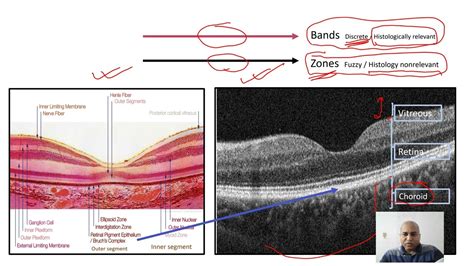 Qualitative analysis of OCT macula: OCT interpretation for macular ...