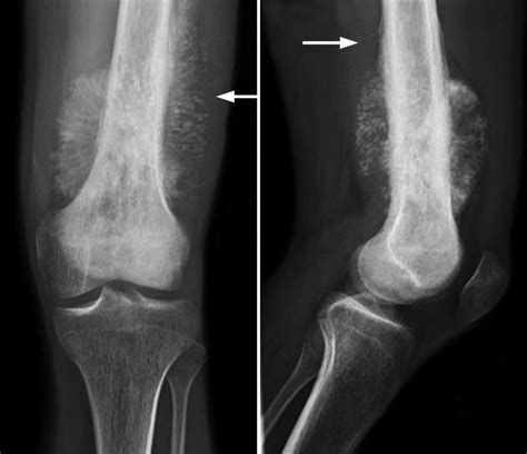 Osteosarcoma - OrthoInfo - AAOS