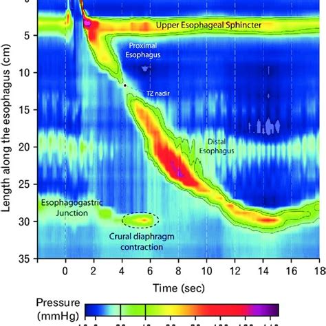 Esophageal high-resolution manometry patterns (from left to right ...