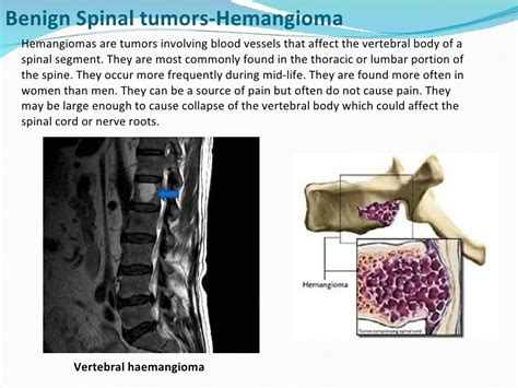 Spinal tumors lecture