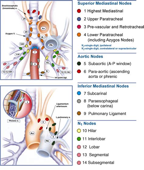 Figure 1 from ESTS guidelines for intraoperative lymph node staging in non-small cell lung ...