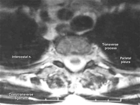 Intercostal Block - TeachMe Orthopedics