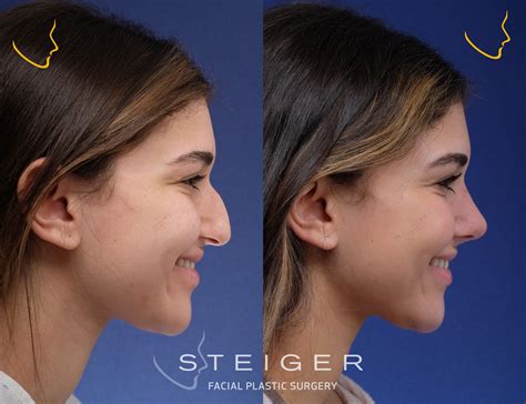 rhinoplasty-before-and-after-droopy-tip | Steiger Facial Plastic ...